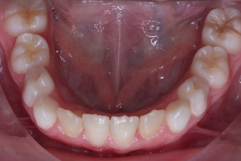 Traitement orthodontique partiel chez l’enfant correction espace à la dentition inférieure après