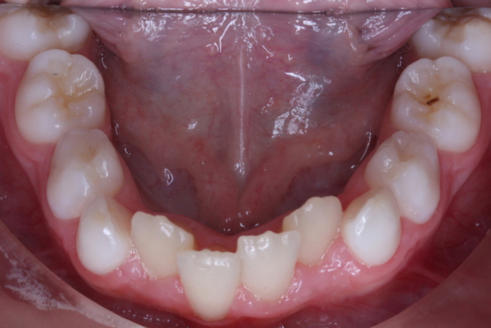 Traitement orthodontique partiel chez l’enfant correction espace à la dentition inférieure avant