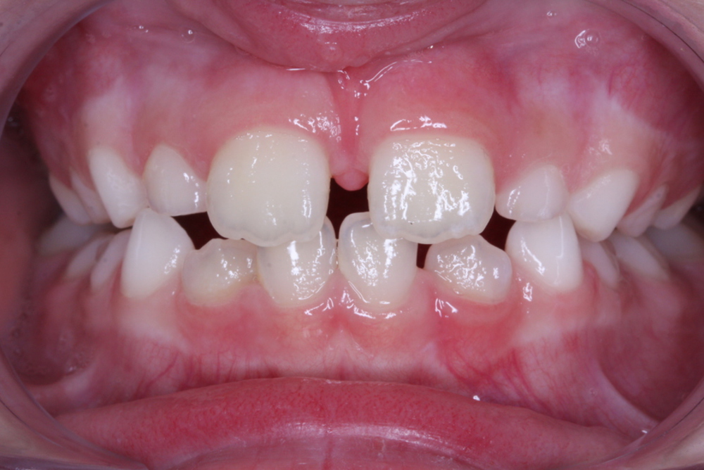 Traitement orthodontique partiel chez l’enfant pour la correction d’un articulé croisé antérieur après