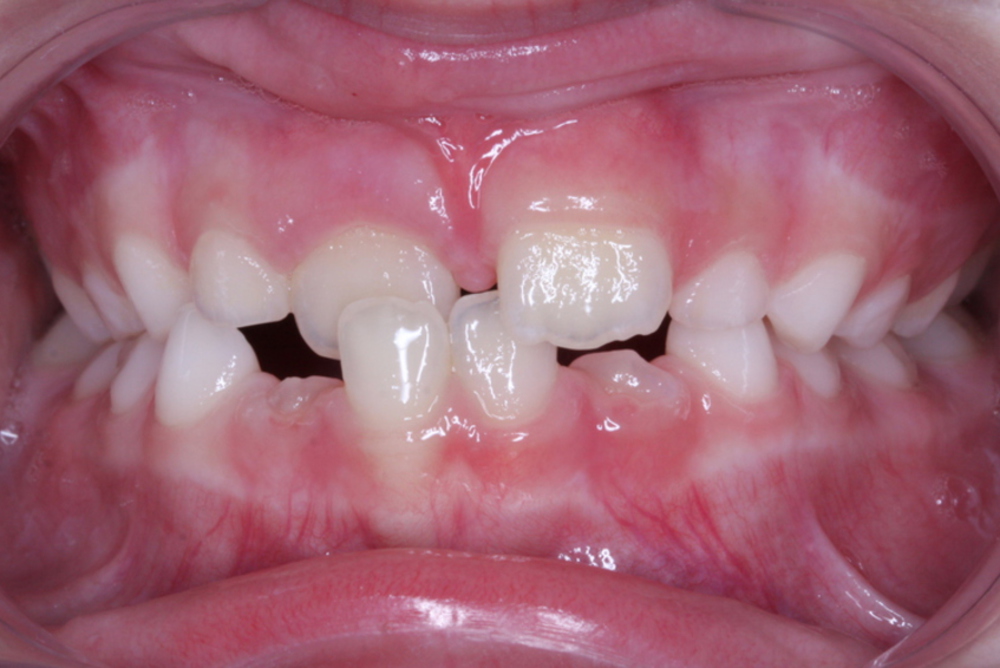 Traitement orthodontique partiel chez l’enfant pour la correction d’un articulé croisé antérieur avant