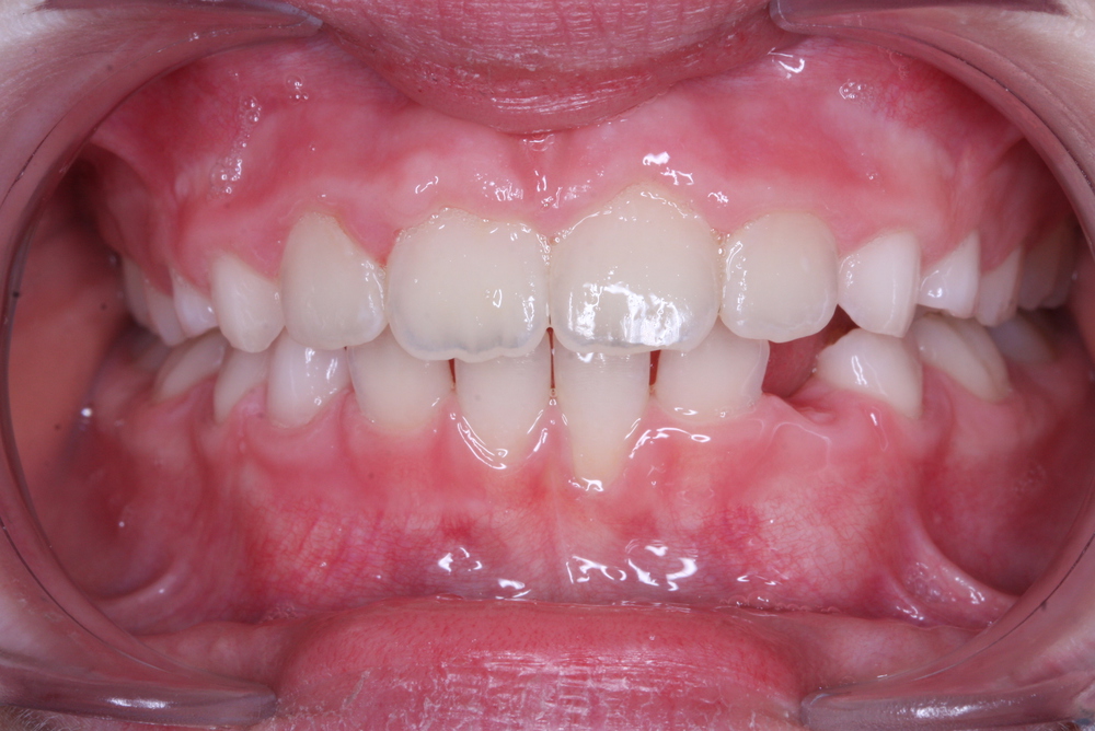 Traitement orthodontique partiel chez l’enfant, correction d’une rotation importante incisive supérieure après