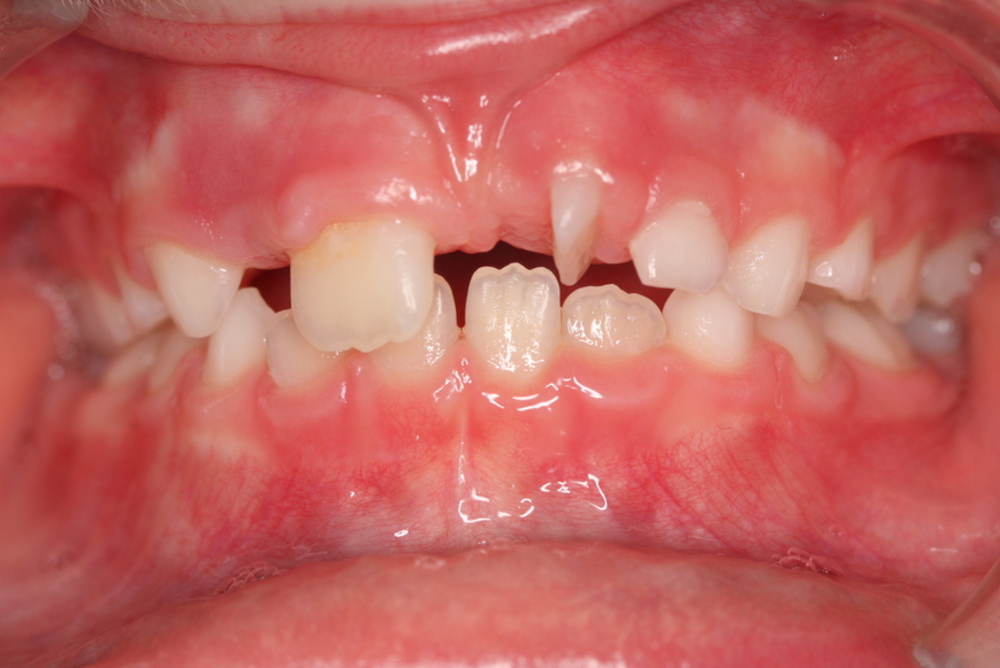 Traitement orthodontique partiel chez l’enfant correction d’un palais étroit manque d’espace à la dentition supérieure avant