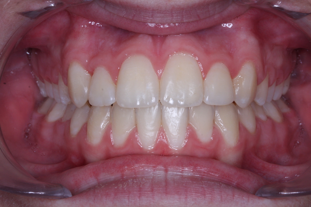 Traitements orthodontiques Orthodontiste Québec Dr Claude Gariépy