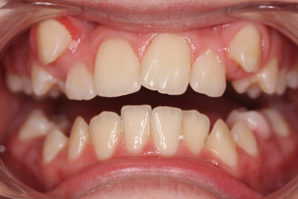 Traitement orthodontique complet chez l’adolescent correction malocclusion chevauchement dentaire important broches orthodontiques avant