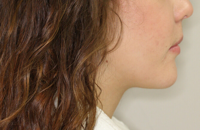 Traitement orthodontique chez une jeune adulte correction d’une malocclusion, broches orthodontiques, chirurgie d’avancement du maxillaire supérieur et recul mandibulaire après