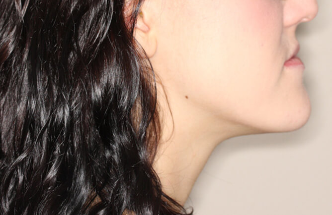 Traitement orthodontique chez une jeune adulte correction d’une malocclusion, broches orthodontiques, chirurgie d’avancement du maxillaire supérieur et recul mandibulaire avant