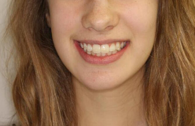 Traitement orthodontique chez l’adolescent correction d’une malocclusion et sourire gingival Chirurgie bi-maxillaire après