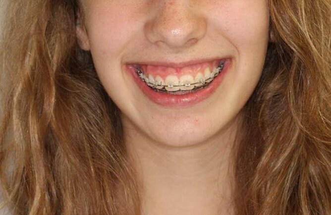 Traitement orthodontique chez l’adolescent correction d’une malocclusion et sourire gingival avant