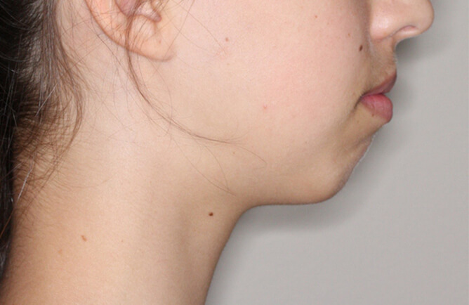 Traitement orthodontique Génioplastie avancement chirurgical du menton avant