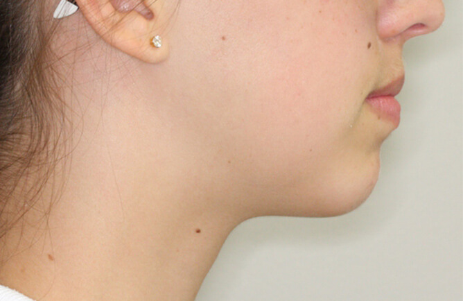 Traitement orthodontique Génioplastie avancement chirurgical du menton après