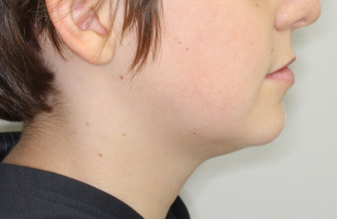 Traitement orthodontique complet chez l’adolescent correction d’une malocclusion après