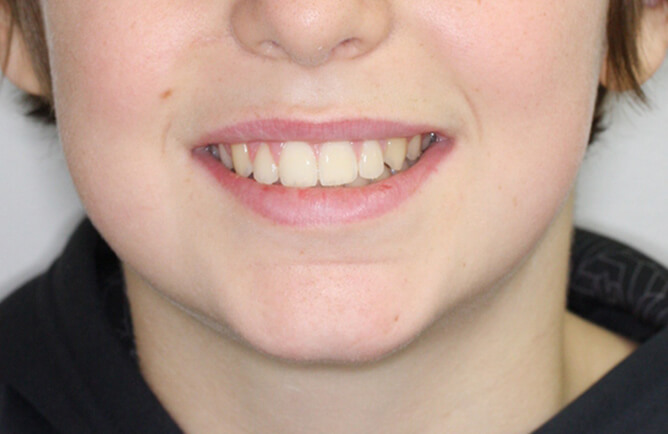 Traitement orthodontique complet chez l’adolescent correction d’une malocclusion après