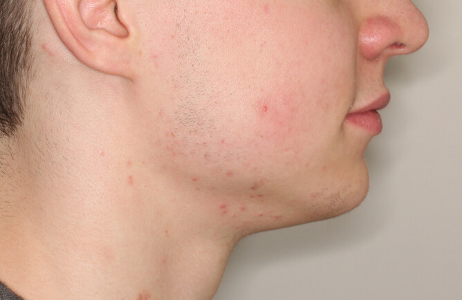 Traitement orthodontique partiel chez l’enfant correction espace à la dentition inférieure après