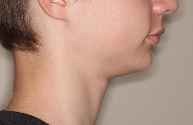 Traitement orthodontique chez un adolescent correction d’une malocclusionbroches orthodontiques, Chirurgie d’avancement mandibulaire avant