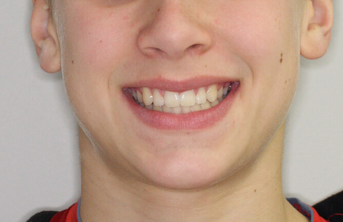 Traitement orthodontique chez un adolescent correction d’un diastème entre les incisives centrales, broches orthodontiques après