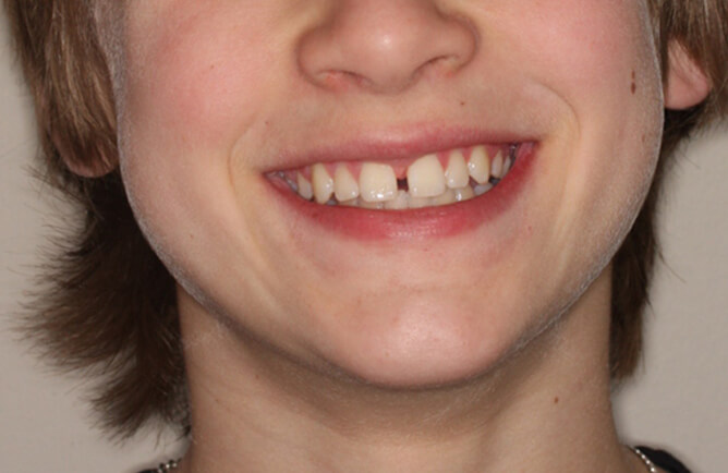 Traitement orthodontique chez un adolescent correction d’un diastème entre les incisives centrales, broches orthodontiques avant